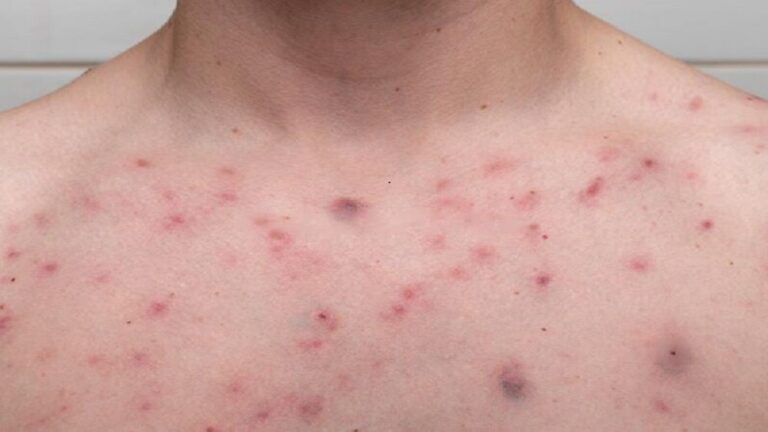 How To Get Rid of Chest Acne